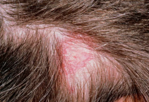 Itchy Spot on Head Losing Hair
