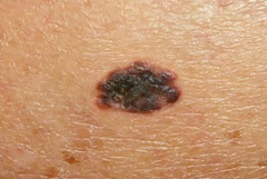 Skin Cancer - Melanoma image - Dermatologist Mesa Arizona, Gilbert Arizona, Chandler Arizona, Queen Creek Arizona
